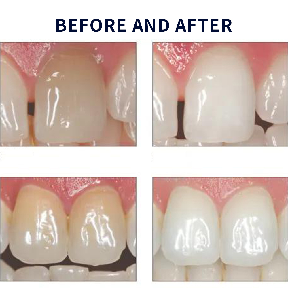 Opalescence Whitening 20% PF 2 - Teeth Whitening Flash 리뷰 및 가격
