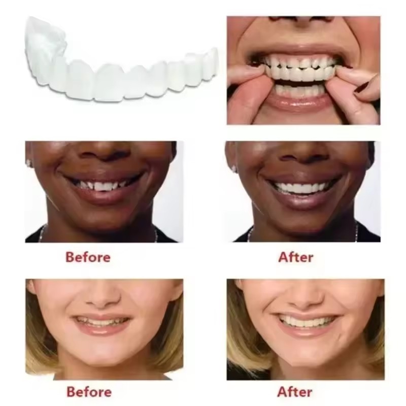 Teeth Veneers Whitening Dentur - Teeth Whitening With Braces 리뷰 및 가격