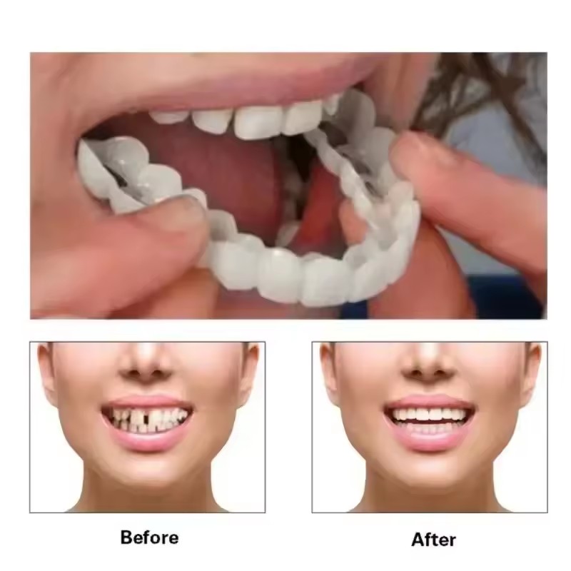 Teeth Veneers Whitening Dentur - Teeth Whitening With Braces 리뷰 및 가격