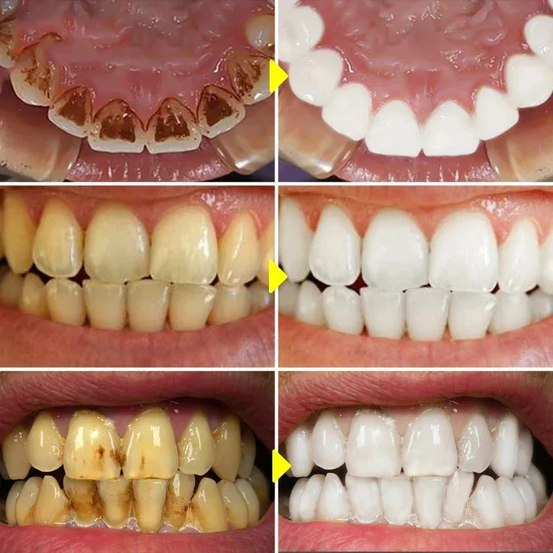 Teeth Whitening Toothpaste Fru - Teeth Whitening Xylitol 리뷰 및 가격