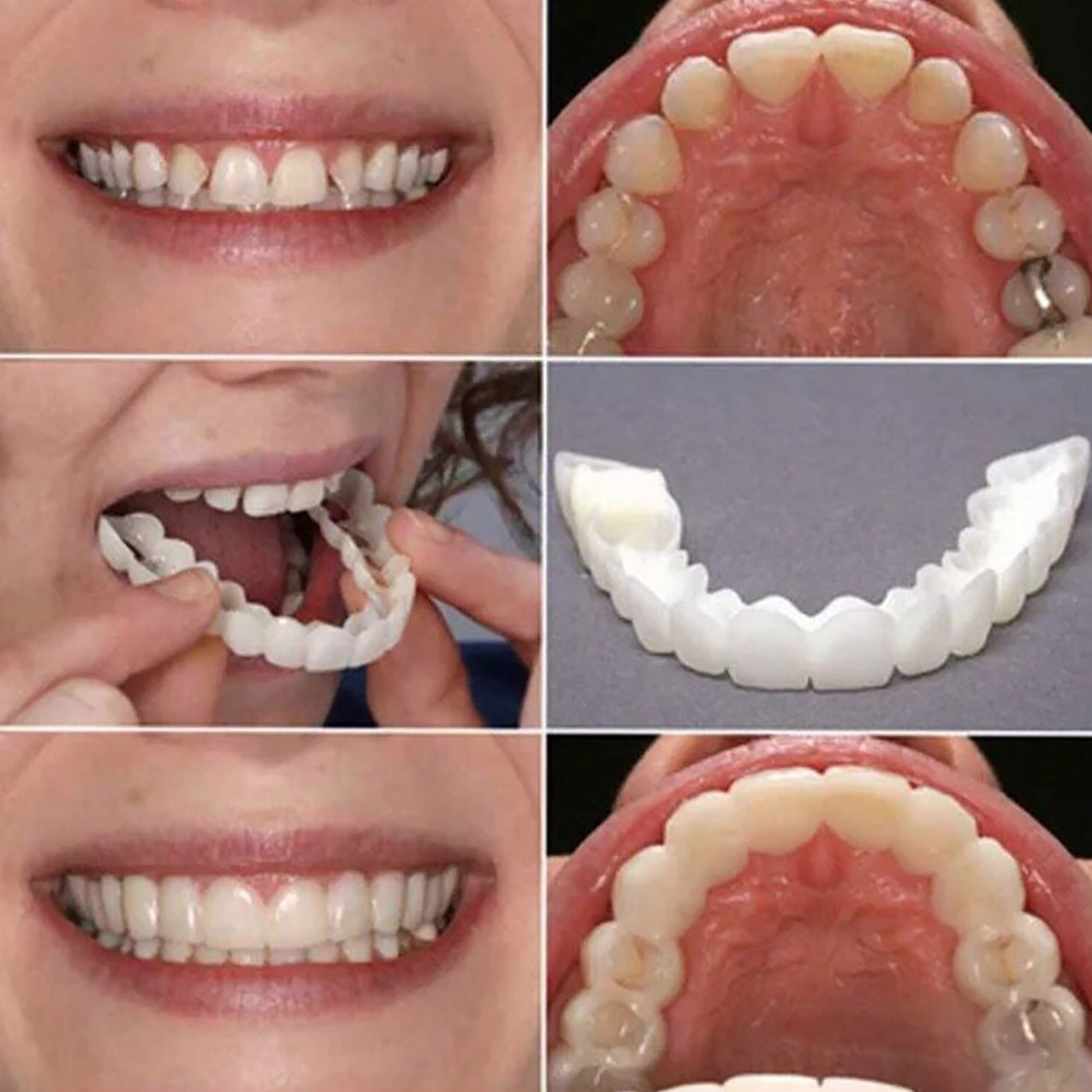 Hot Teeth Veneers Whitening De - Teeth Whitening With Braces 리뷰 및 가격