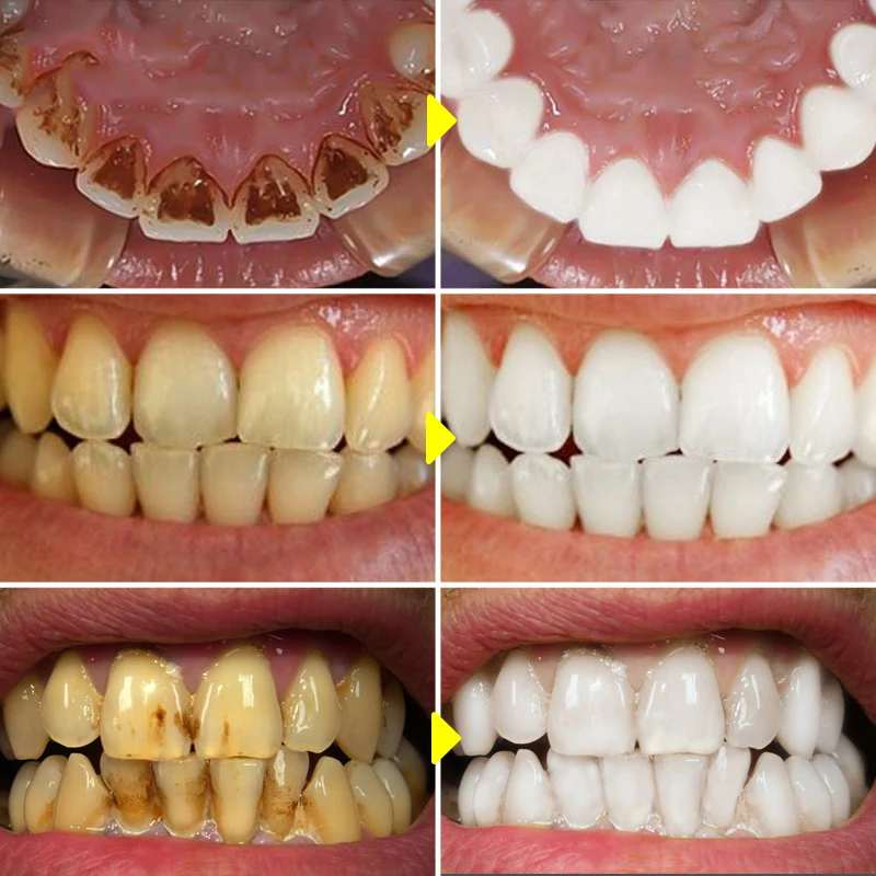 V34 Teeth Whitening Mousse Too - Teeth Whitening Xylitol 리뷰 및 가격