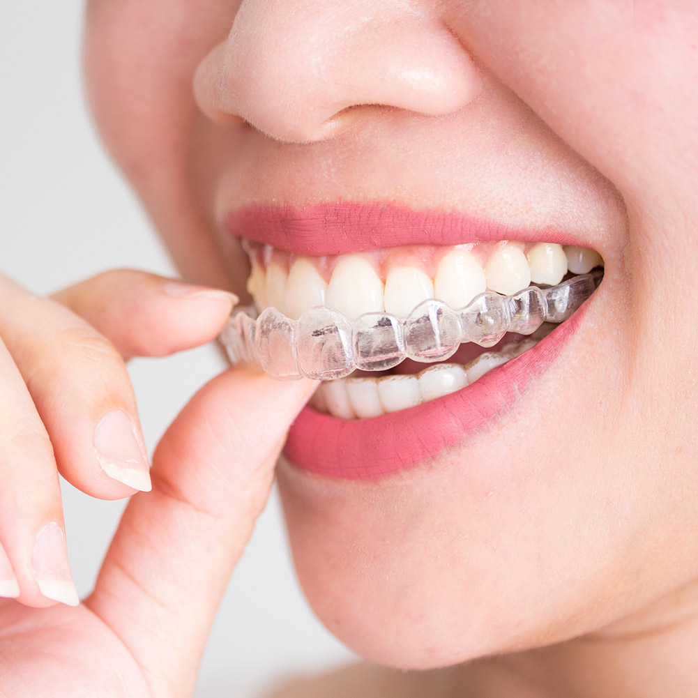 2/4pcs Mouth Guard Teeth Prote - Teeth Whitening With Braces 리뷰 및 가격