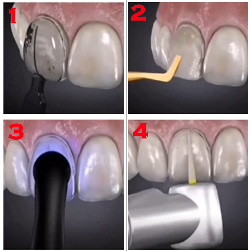32pcs Dental Veneer Mould Kit  - Teeth Whitening Moulds 리뷰 및 가격