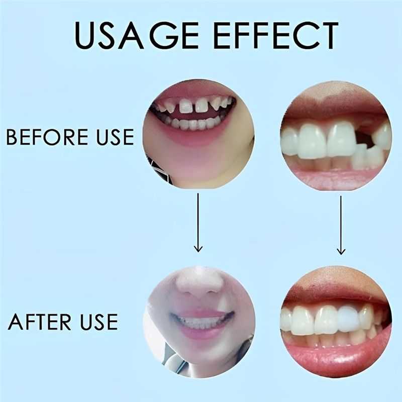 [NEW!ABMK】 2 Pairs,Regain Beau - Teeth Whitening With Braces 리뷰 및 가격